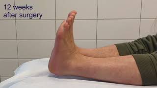 calcaneus fracture comminuted Sanders 4  minimal invasive surgery  clinical course [upl. by Winters250]