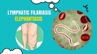 Unlocking the Secrets of Elephantiasis What You Need to Know [upl. by Pail]