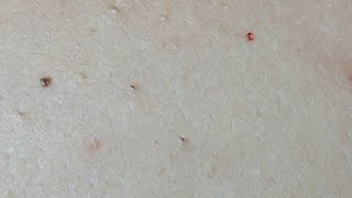 Acne Treatment on the Back Uninfected Lesions [upl. by Cirred958]