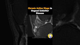 Fig 4B18 Osgood Schlatter Disease Chronic Active Stage [upl. by Avilla]