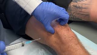 KNEE Intraarticular injection of Local Anaesthetic and Steroid [upl. by Nolrev]