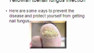 toe nail fungus home remedies [upl. by Kyle]