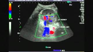 Left renal artery color doppler video [upl. by Nwahsuq]