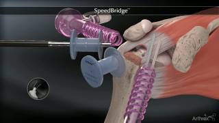 Réparation de la coiffe des rotateurs de lépaule sous arthroscopie [upl. by Tova464]