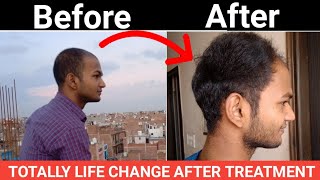 Homeopathy Result After Use 5 Month।Sonu Kumar Mishra। [upl. by Gilboa]