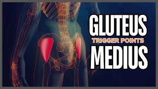 Understanding Gluteus Medius Trigger Points [upl. by Astra]