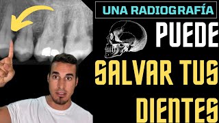 Una simple RADIOGRAFÍA podría SALVAR tus dientes 🛟  SARRO DENTAL [upl. by Lemraj]