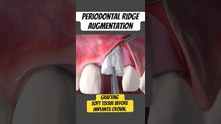 Ridge Augmentation Soft tissue Grafting Dental Implants [upl. by Sidnal]