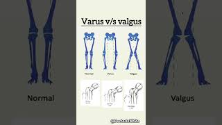 Varus vs valgus  viralshorts varus valgus foot medicine [upl. by Ennavoj]