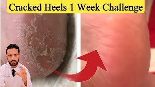 Cracked Heels 1 Week Solution  Quick Cracked Heel Treatment [upl. by Eikcaj809]