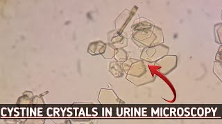 Cystine crystals seen in urine microscopyBest crystals view in microscopeUrine routine examination [upl. by Scarlett]