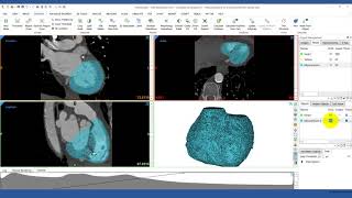 How to Add Myocardium to Your Heart Model in Materialise 3matic  Mimics Innovation Suite [upl. by Yrohcaz]