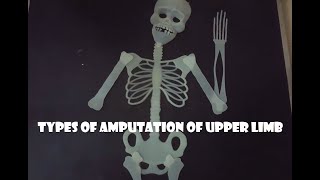 Upper limb amputation types [upl. by Brunelle]