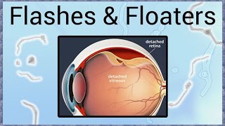 Flashes amp Floaters  A Sign of Retinal Detachment [upl. by Anaitsirc]