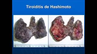 TIROIDITIS DE HASHIMOTO [upl. by Souvaine]