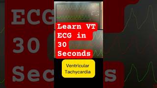 Ventricular tachycardia ecg amp treatment cardiology in 30 seconds [upl. by Nayab]