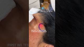 Laser treatment for hyperpigmentation oddlysatisfying hyperpigmentation [upl. by Lizbeth]