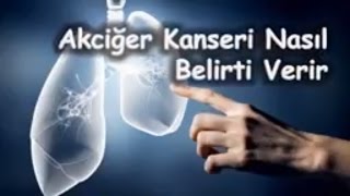 Akciğer Kanseri Nasıl Belirti Verir [upl. by Aloibaf]