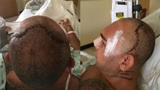 CYBORG SANTOS ENDANGERS LIFE FIGHTING IN BELLATOR CAGE DECEMBER AFTER CRUSHED SKULL SURGERY [upl. by Erihppas]