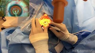 Dr Ike Ahmed ZEPTO® Precision Cataract Surgery Capsulotomy System Video 2 of 2 [upl. by Alyahc433]