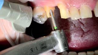 Emax Cad Cerec Brigde Full clinical case in PAG technique c Dr J Raynal [upl. by Desiree]