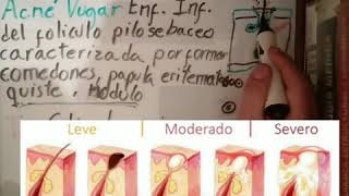 Erysipelothrix RhusiopathiaeListeria MonocytogenesCutibacterium Acnes Corynebacterium Diphtheriae [upl. by Nahtad]