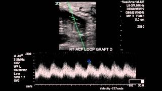 Right Arm AV Graft Duplex  Case Study [upl. by Ameh]