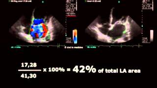 Volodymyr Pavliuk MD PhD Echocardiographic Assesment of Mitral Regurgitation [upl. by Cran]