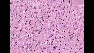 Histopathology BrainAstrocytoma [upl. by Gold]