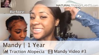 Traction Alopecia Regrowth 2021  I Got My Edges Back After Traction Alopecia Mandy [upl. by Curkell]