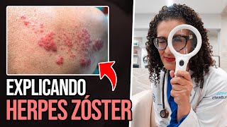 Herpes Zoster  Sintomas Complicações e Prevenção [upl. by Brubaker943]