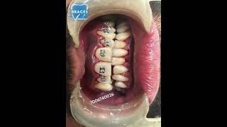 Class 2 div 1 Malocclusion  BRACES trending dentist toothdental dentalcare dentalclinic tooth [upl. by Rouvin]