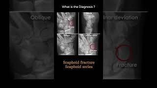 Scaphoid fracture  Scaphoid series 141Trauma Xray  Upper limb gallery 2radiologychannel007 [upl. by Zetroc]