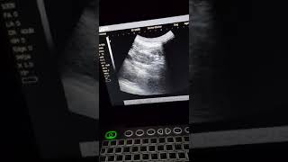 Teeter Ultrasound [upl. by Meenen]