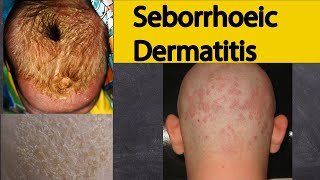 Seborrhoeic dermatitis  Explained under 3 minutes Seborrheic dermatitis Symptoms and treatment [upl. by Rafat]