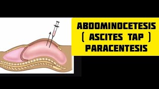 Ascites tap procedure  paracentesis  abdominocetesisn medics skills shorts [upl. by Silvia]