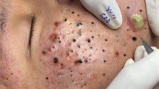 Big Cystic Acne Blackheads Extraction Blackheads amp Milia Whiteheads Removal Pimple Popping  7043 [upl. by Nya]