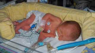 32 week Preemie Samuels Month in NICU and Year [upl. by Audry]