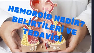 Hemoroid nedir Belirtileri ve tedavisi [upl. by Biddick]