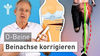 Umstellungsosteotomie Knie OBeine durch OP korrigieren [upl. by Kristine]