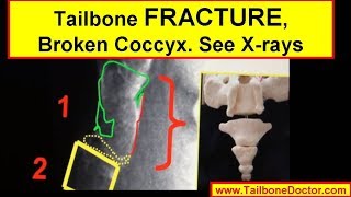 Xrays showing COCCYX FRACTURE broken tailbone [upl. by Kristan]