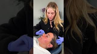 VI Peel for Acne amp Acne Scarring with Nurse Lauren [upl. by Netfa315]