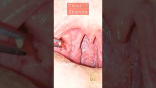 Tonsil Stones Removal Procedure [upl. by Whitnell617]