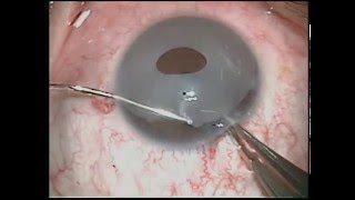 Eye Color Change New iris Implant removal exhanged to Brightocular [upl. by Aisatna]