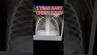 1 year baby chest x ray shortvideo [upl. by Oironoh]