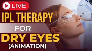 IPL Therapy for Dry Eye Relief I StepbyStep Procedure [upl. by Noillid]