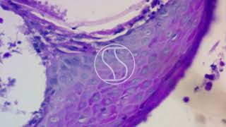 Rhinosporidiosis under the microscope with Periodic acidSchiff PAS stain [upl. by Ilwain938]