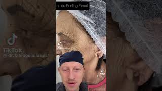 Incredible Chemical Peel Result  Plastic Surgeon Reacts [upl. by Columbyne]