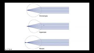 Emmetropia Hyperopia amp Myopia [upl. by Nanek]