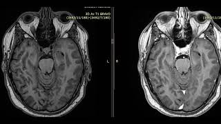 case 19 52 year male from ICU subacute infarct mimic neoplasm [upl. by Thomas651]